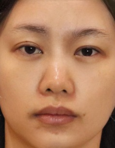 去眼袋手术