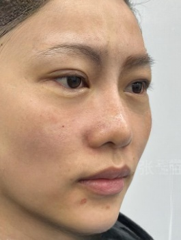 去眼袋手术