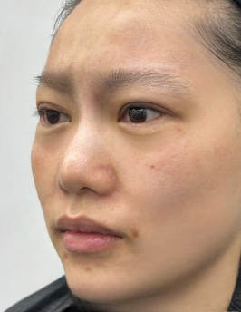 去眼袋手术