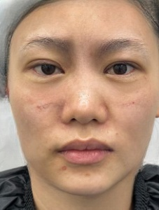 去眼袋手术