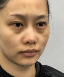 去眼袋手术