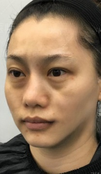 去眼袋手术