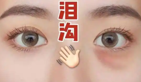 泪沟
