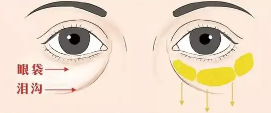 去眼袋手术