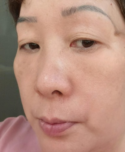 去眼袋手术
