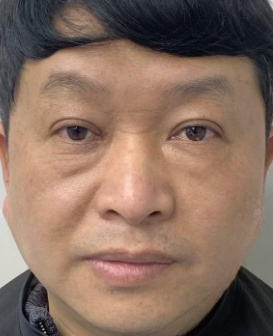 去眼袋手术
