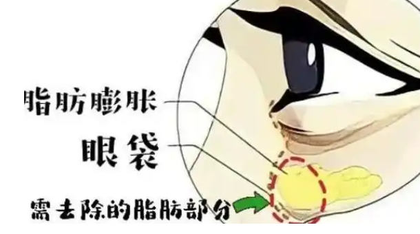 去眼袋手术