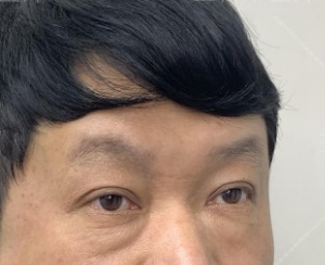 去眼袋手术