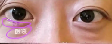 眼袋
