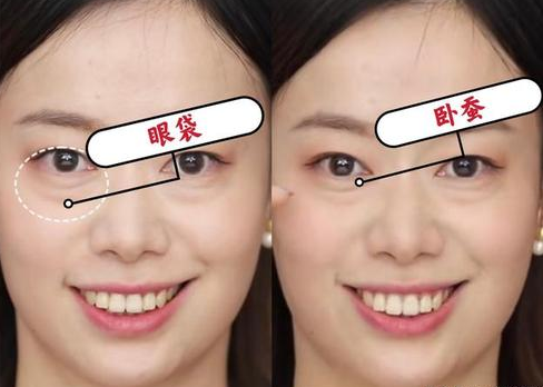 眼袋