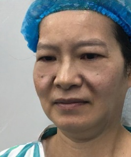 去眼袋手术