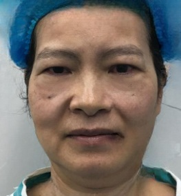 去眼袋手术
