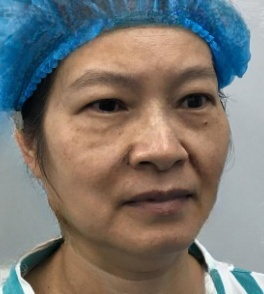 去眼袋手术