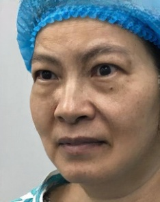去眼袋手术