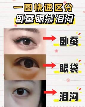 去眼袋手术