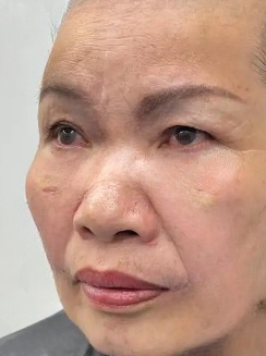 去眼袋手术