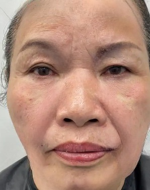 去眼袋手术
