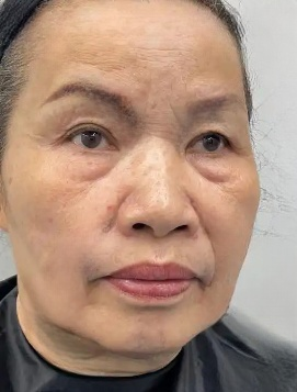 去眼袋手术