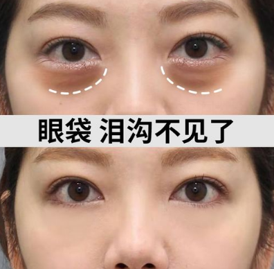 去眼袋手术