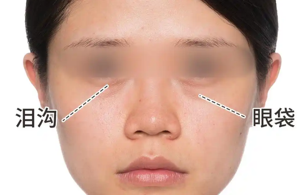 去眼袋手术