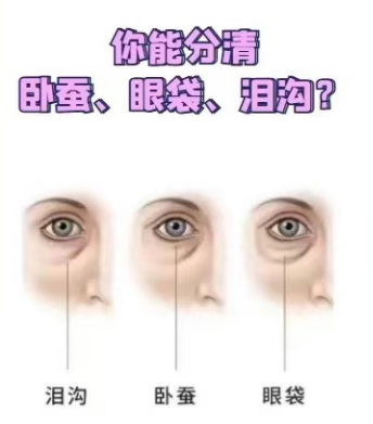 去眼袋手术