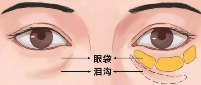 去眼袋手术