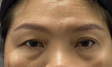 去眼袋手术