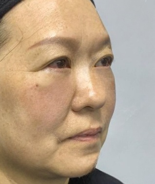 去眼袋手术