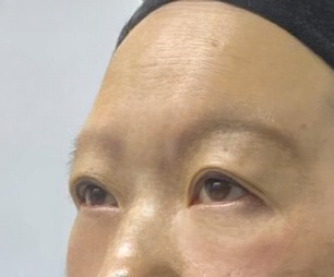去眼袋手术