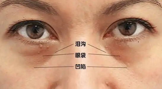 去眼袋手术