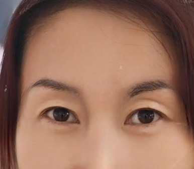 去眼袋手术