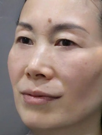 去眼袋手术