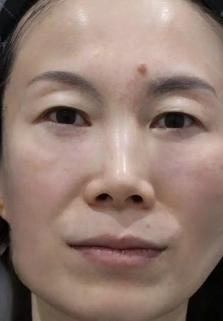 去眼袋手术