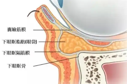 去眼袋手术
