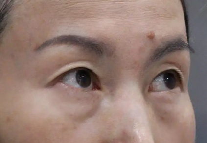 去眼袋手术