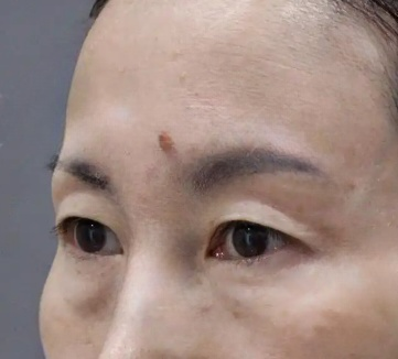 去眼袋手术