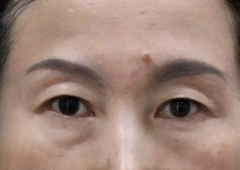 去眼袋手术