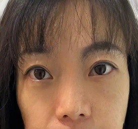去眼袋手术