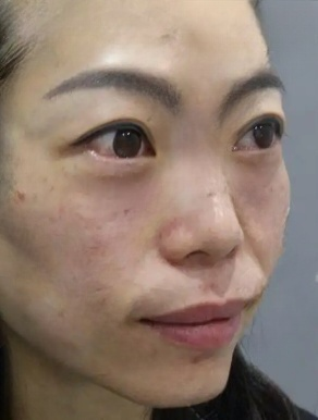 去眼袋手术