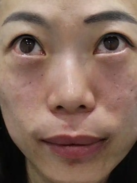 去眼袋手术