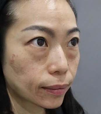 去眼袋手术