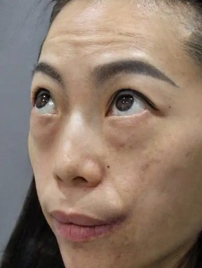 去眼袋手术