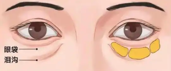 去眼袋手术
