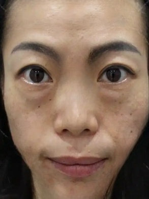 去眼袋手术