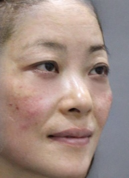 去眼袋手术