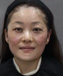 去眼袋手术