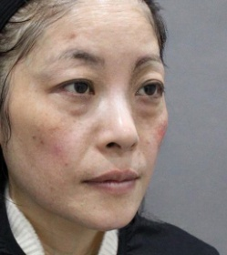 去眼袋手术