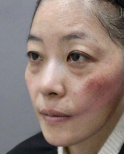 去眼袋手术