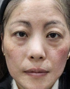 去眼袋手术