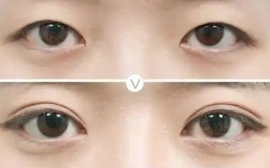 双眼皮
